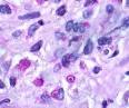 Pulmonary <b>Malacoplakia</b> and