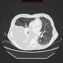 <b>Lymphangioléiomyomatose</b>