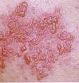 Positive Health Online | Article - Applied Phytomedicine Treatment ...
