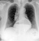 File:<b>Radiografía</b> pulmones