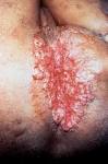 <b>granuloma inguinale</b>