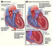Congenital heart defect - Wikipedia, the free encyclopedia
