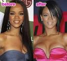 Celebrities Before and After Breast Implants   Damn Cool Pictures