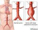 Abdominal <b>Aortic Aneurysms</b>