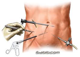    Chronic Cholecystitis 