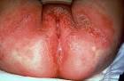 KAWASAKI DISEASE Picture (Hardin MD Super Site Sample)