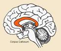 corpus callosum - multiple sclerosis encyclopaedia