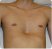 <b>chest</b> or <b>funnel chest</b>.