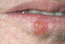 Kissing Health