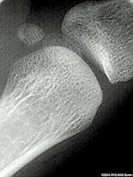 File:Radiographie de l\u0026#39;articulation du pouce (métacarpe 1-phalange proximale) et des os sésamoïdes.jpg - Radiographie_de_l'articulation_du_pouce_(métacarpe_1-phalange_proximale)_et_des_os_sésamoïdes