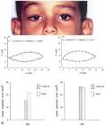 A, unilateral congenital