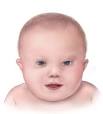 CDC - Birth Defects, Down Syndrome - NCBDDD