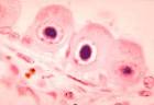 File:Histopathology of cytomegalovirus infection of kidney - PHIL ...