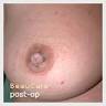 inverted nipple correction
