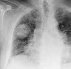 Harry's Chest Radiology Atlas :: Congenital :: Hamartoma2a