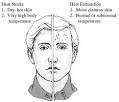 Heat Stroke Symptoms : Symptoms of Heat Stroke | Heat Stroke Symptoms