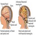 How To Recognize Meningitis Symptoms - Signs And Symptoms Of.