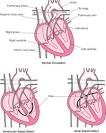 <b>Heart Defects</b>: Birth <b>Defects</b>: Merck Manual Home Edition