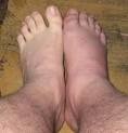 Gout attack - Right Ankle | Flickr - Photo Sharing!
