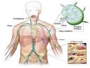 <b>Linfoma</b> a <b>cellule miste</b>