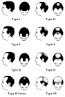 Norwood scale of male pattern baldness