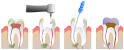 400px-Root_Canal_Illustration_ ...