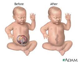 omphalocele