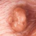 Discovery Health "How Common Warts Work"