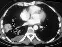 PULMONARY EMBOLISM