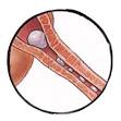 FELINE UROLOGiCAL SYNDROME (
