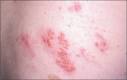 Herpes Zoster and Postherpetic Neuralgia: Prevention and ...