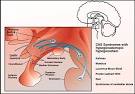 of <b>Kallmann's Syndrome</b>