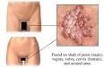 Blue Waffle Disease STD's | Blue Waffle Disease Pictures and Articles