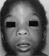 syndrome, fetal alcohol,