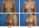 Breast Augmentation Surgery Before and After Picture Greensboro ...