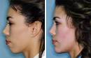 A chin augmentation will