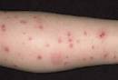 Bug Bites Pictures Slideshow: Identifying Bugs and Bug Bites - WebMD