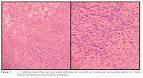 <b>hiperplasia nodular focal</b>