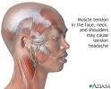 <b>Tension</b>-<b>type headache</b>