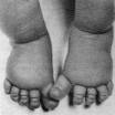 Turner syndrome - Wikipedia, the free encyclopedia