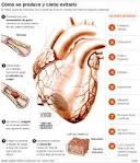 EL <b>INFARTO</b> AGUDO DE <b>MIOCARDIO</b>