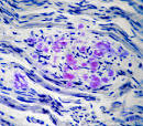<b>Amyloid neuropathy</b>
