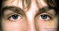 The Eyes Have It: Other Common Symptoms and Signs