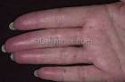 <b>Crest Syndrome</b> Photo