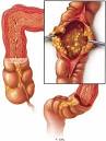 goEBM.COM :: Clostridium difficile