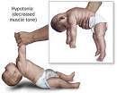 Prader-Willi syndrome