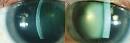 Case of <b>Corneal Edema</b>