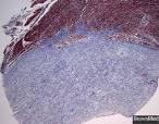 <b>Endocardial fibroelastosis</b>