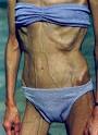 Medusa  ANOREXIC BULIMIC PRO ANA MIA  SOME TIPS IF YOU WANT