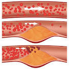 atherosclerosis diagram of